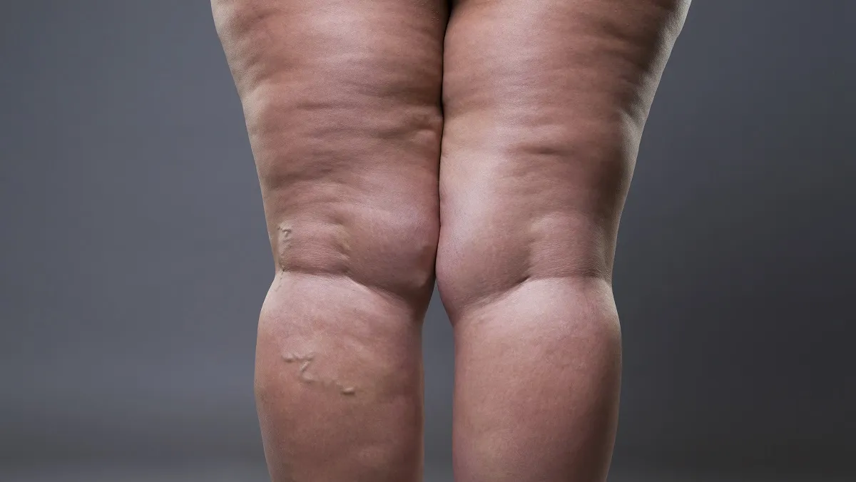 Pernas com sinais clínicos de lipedema em estágio inicial